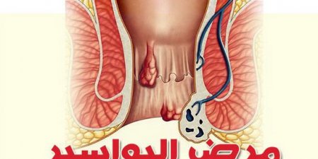 اخبار اليمن اليوم مباشر عاجل بالفيديو...بشرى لكل من يعاني من البواسير : أفضل وأسرع طرق علاج البواسير في منزلك خلال دقائق، بدون جراحة نهائياً (شاهد)